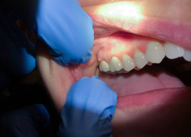 Best Knocked-Out Tooth (Avulsed Tooth) Treatment in Napoleon, OH